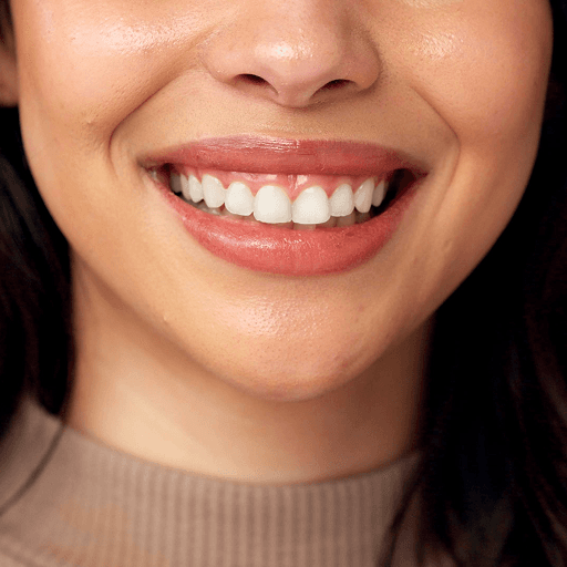 What Are Veneers?